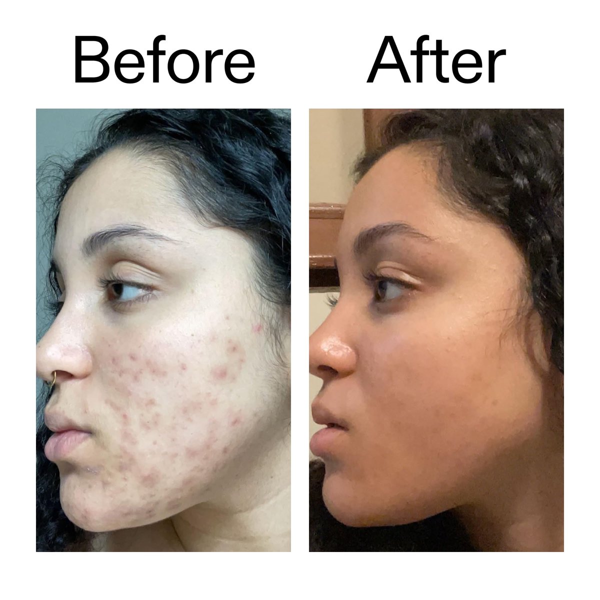 The INKEY List Tranexamic Acid Serum – Reduce Dark Spots & Uneven Skin Tone, 1 fl oz Avelisse