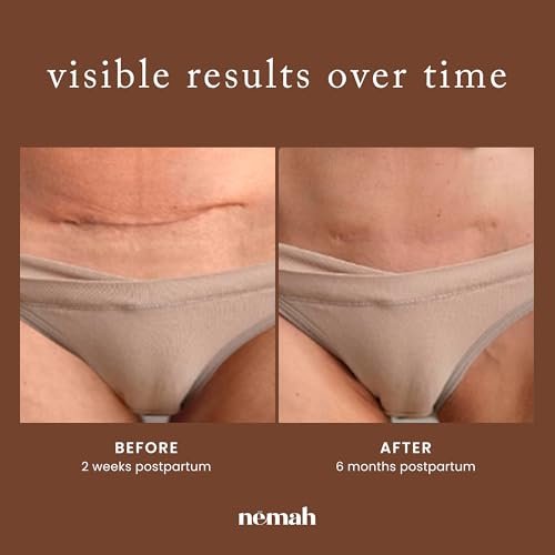 Nemah Restorative Scar Treatment – C-Section Recovery Cream for Surgical Scars, Acne Marks, Dermatologist Approved, Antioxidant Rich Vegan Formula, 1 oz Avelisse
