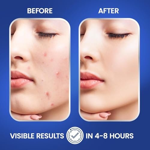 ZITLABS Pimple Patches for Face - Hydrocolloid Acne Patches with Tea Tree Oil & Salicylic Acid - Overnight PM Patches for Zits, Blemishes, Breakouts - Medical-Grade Hydrocolloid - Pack of 72 - görsel 16