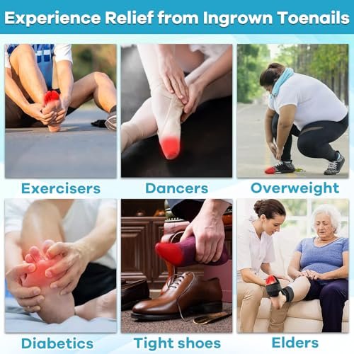 Ingrown Toenail Drop - Effective Pain Reliever and Softener Kit for Men and Women, Ingrown Toenail Corrector Drops, 1 Fl Oz Avelisse