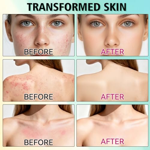 Acne Treatment Cream for Face & Body – Gentle Daily Moisturizer for Oily & Blemish-Prone Skin Avelisse