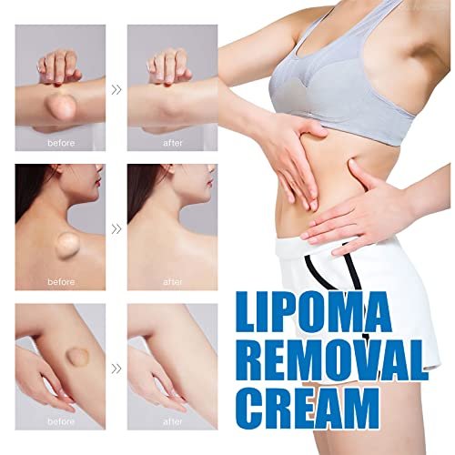 Lipoma Cream with Plant Extracts – Quick Effect Fat Lump Removal, Easy to Use, 20g/0.7oz Avelisse