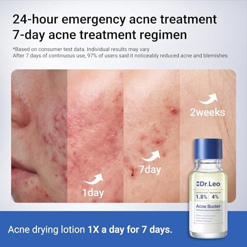 Dr.Leo 1.8% Salicylic Acid Spot Serum - Acne Drying Lotion for Sensitive Skin with Niacinamide, Fast Pimple Relief & Fades Marks, 0.34 fl oz Avelisse