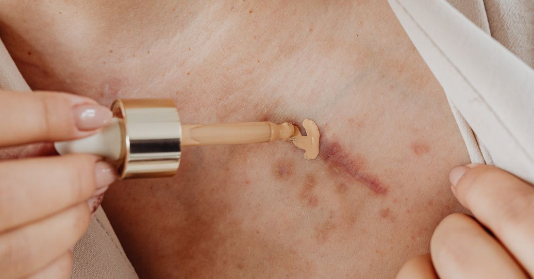 Close-up of an acne scar treatment serum bottle on a clean surface, illustrating how to get rid of acne scars fast with targeted skincare.