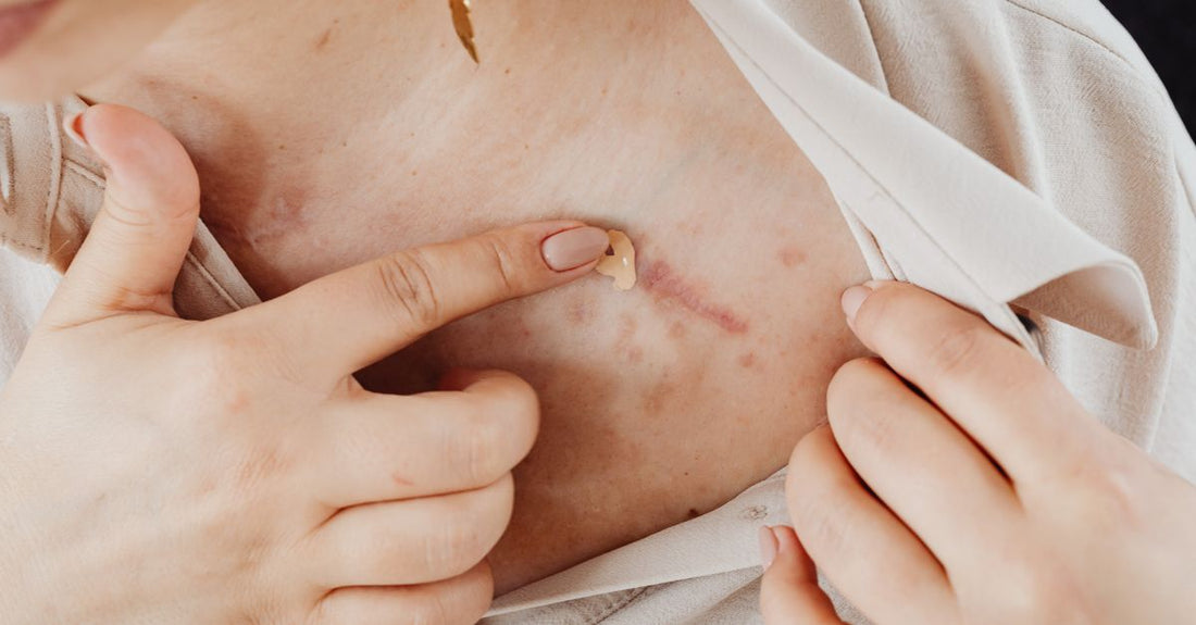How to get rid of acne scars: a selection of clinically proven skincare products arranged on a light marble surface.