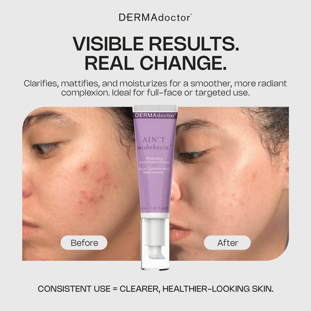 DERMAdoctor Ain't Misbehavin' Salicylic Acid Acne Control Serum – Dermatologist-Formulated Spot Treatment for Cystic Acne & Blemishes with Tea Tree Oil, 1 oz - görsel 5