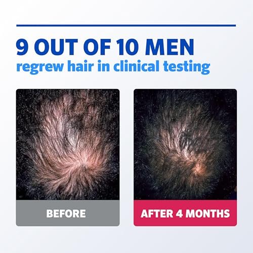 Rogaine 5% Minoxidil Foam for Men – Clinically Proven Hair Regrowth, 3-Month Supply (3 x 2.11 oz), Unscented Avelisse