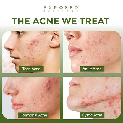 Exposed Skin Care Acne Facial Cleanser – Gentle Daily Face Wash with 0.5% Salicylic Acid for Sensitive & Acne-Prone Skin, Breakouts, Blackheads & Excess Oil – Natural, Non-Toxic & Cruelty Free (4 Fl Oz) Avelisse