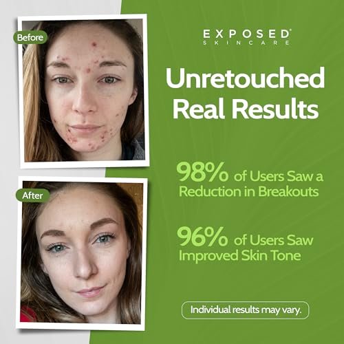 Exposed Skin Care Acne Facial Cleanser – Gentle Daily Face Wash with 0.5% Salicylic Acid for Sensitive & Acne-Prone Skin, Breakouts, Blackheads & Excess Oil – Natural, Non-Toxic & Cruelty Free (4 Fl Oz) Avelisse