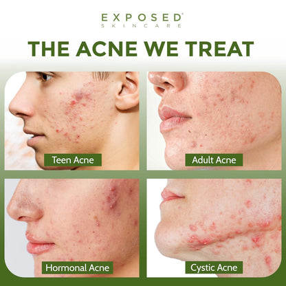 Exposed Skin Care Acne Facial Cleanser – Gentle Daily Face Wash with 0.5% Salicylic Acid for Sensitive & Acne-Prone Skin, Breakouts, Blackheads & Excess Oil – Natural, Non-Toxic & Cruelty Free (4 Fl Oz) Avelisse