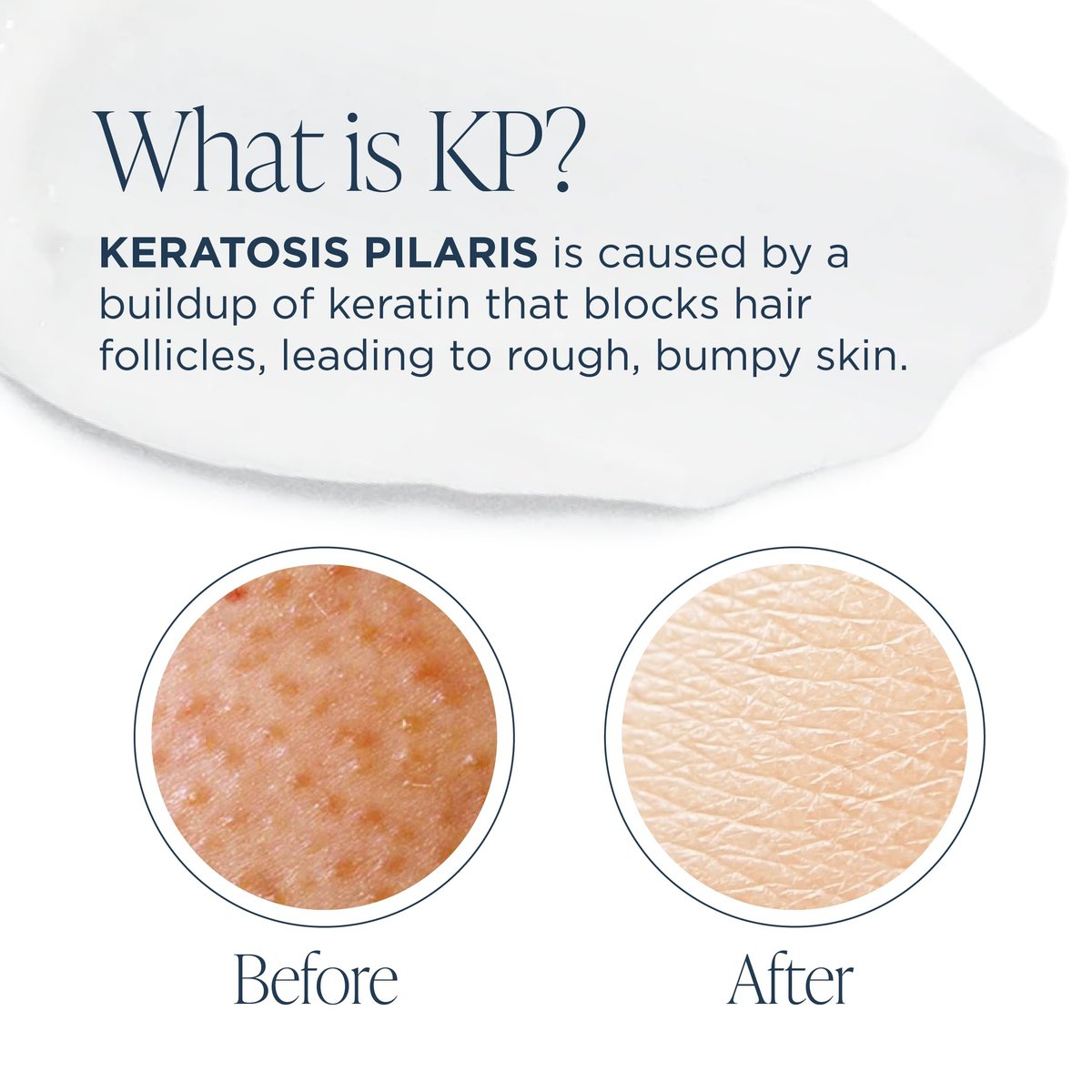 Glytone KP Kit – Exfoliating Body Wash, Glycolic Acid Lotion & Shower Pouf for Keratosis Pilaris – Smooth Rough Bumpy Skin, Fragrance-Free Skincare Routine for Dry Skin & Chicken Skin – Routine Kit Avelisse