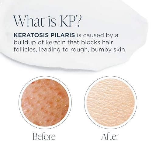 Glytone KP Kit – Exfoliating Body Wash, Glycolic Acid Lotion & Shower Pouf for Keratosis Pilaris – Smooth Rough Bumpy Skin, Fragrance-Free Skincare Routine for Dry Skin & Chicken Skin – Routine Kit Avelisse