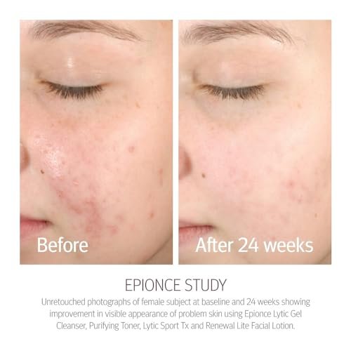 Epionce Renewal Lite Facial Lotion – Lightweight Hydrating Anti-Aging Moisturizer for Combination to Oily & Problem Skin Avelisse