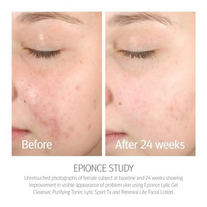 Epionce Renewal Lite Facial Lotion – Lightweight Hydrating Anti-Aging Moisturizer for Combination to Oily & Problem Skin Avelisse