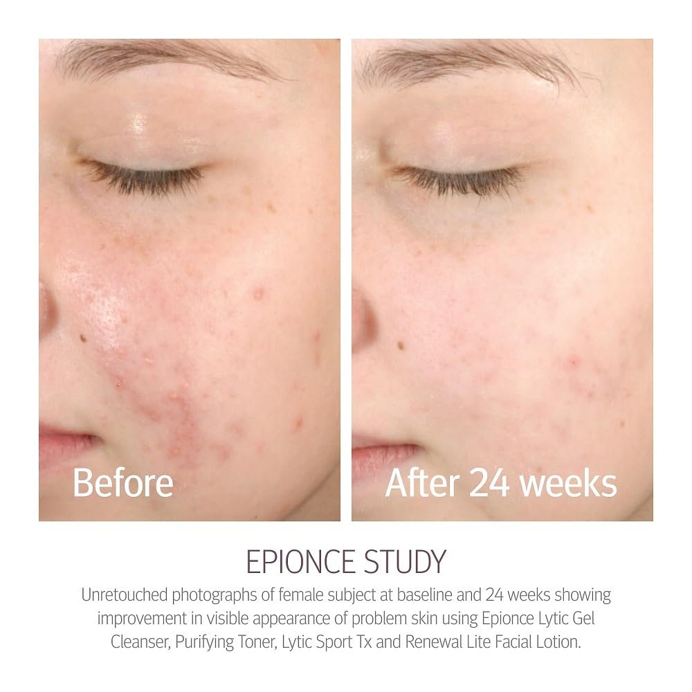 Epionce Renewal Lite Facial Lotion – Lightweight Hydrating Anti-Aging Moisturizer for Combination to Oily & Problem Skin Avelisse