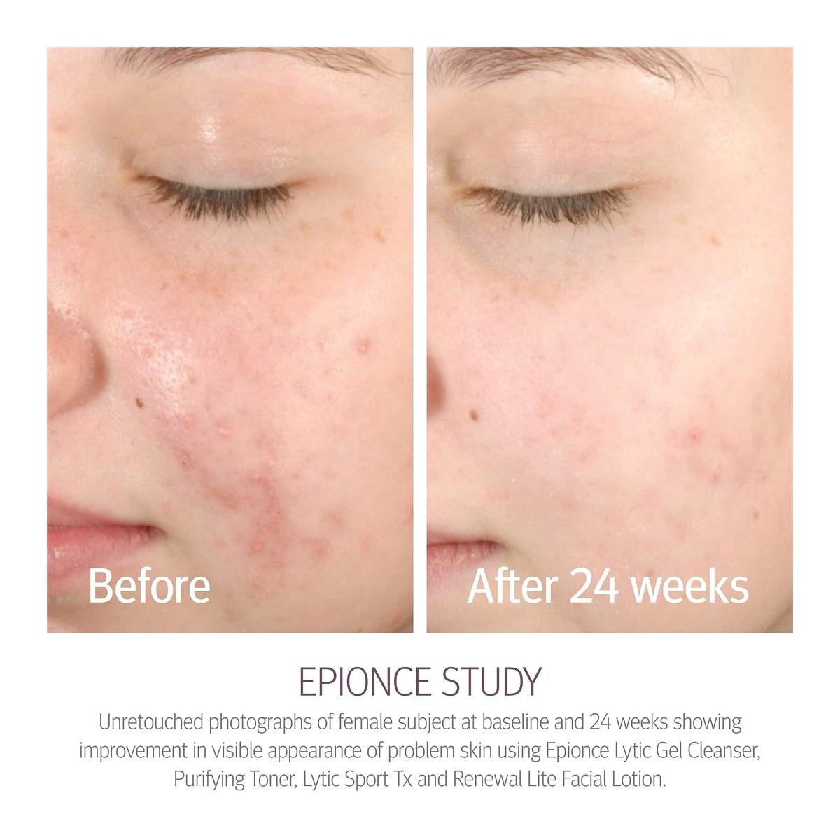 Epionce Purifying Toner – Gentle Acne & Blackhead Control Toner for Face & Body, Removes Dirt, Oil & Makeup, with Willow Bark, Cucumber & Menthol, Dermatologist-Developed, 4 Fl Oz Avelisse