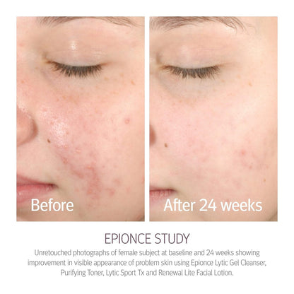 Epionce Purifying Toner – Gentle Acne & Blackhead Control Toner for Face & Body, Removes Dirt, Oil & Makeup, with Willow Bark, Cucumber & Menthol, Dermatologist-Developed, 4 Fl Oz Avelisse