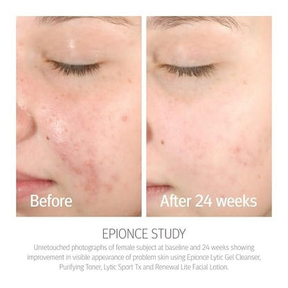 Epionce Purifying Toner – Gentle Acne & Blackhead Control Toner for Face & Body, Removes Dirt, Oil & Makeup, with Willow Bark, Cucumber & Menthol, Dermatologist-Developed, 4 Fl Oz Avelisse