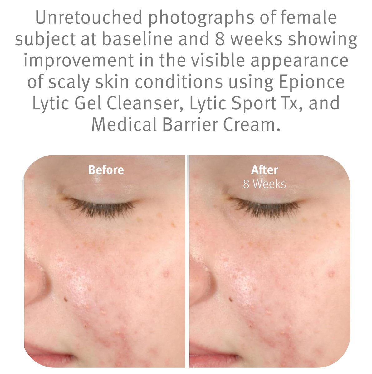 Epionce Lytic Gel Cleanser – Gentle Foaming Face Wash & Makeup Remover for Oily, Combination & Problem Skin | Acne & Oil-Control Cleanser with Willow Bark | Dermatologist Skincare Avelisse