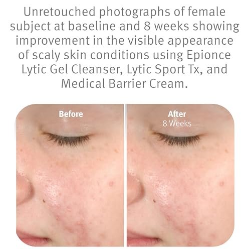 Epionce Lytic Gel Cleanser – Gentle Foaming Face Wash & Makeup Remover for Oily, Combination & Problem Skin | Acne & Oil-Control Cleanser with Willow Bark | Dermatologist Skincare Avelisse