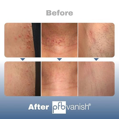 PFB Vanish Razor Bump Stopper Roll On Shaving Gel – Ingrown Hair & Razor Burn Treatment, 3.2 oz Avelisse