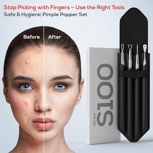 Suvorna Pimple Popper Tool Kit – 4-Piece Stainless Steel Blackhead & Comedone Extractor Set for Facial Extraction Avelisse