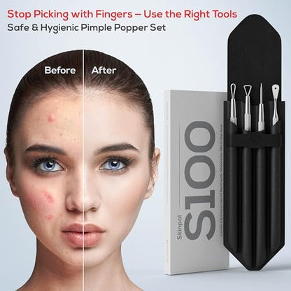 Suvorna Pimple Popper Tool Kit – 4-Piece Stainless Steel Blackhead & Comedone Extractor Set for Facial Extraction Avelisse
