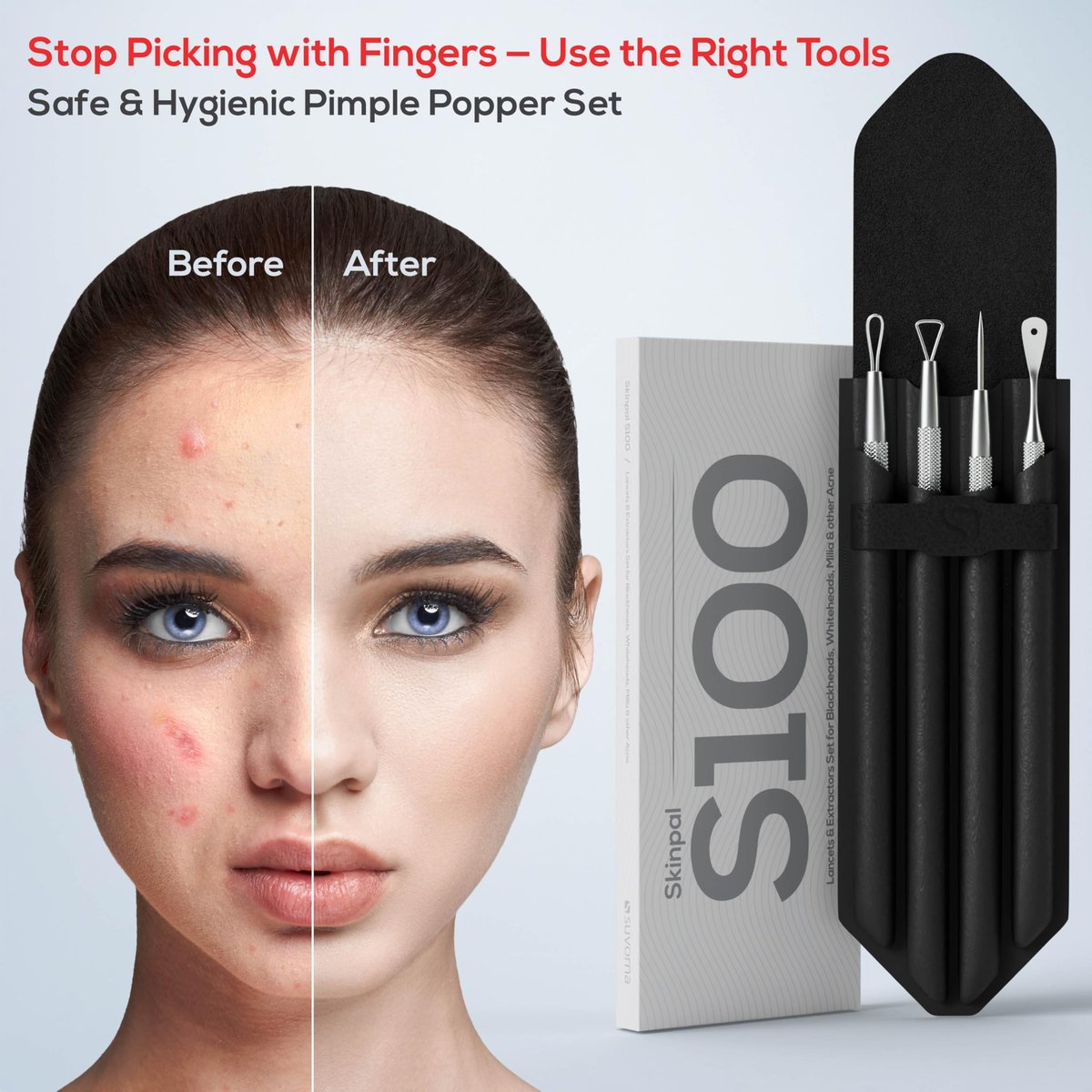 Suvorna Pimple Popper Tool Kit – 4-Piece Stainless Steel Blackhead & Comedone Extractor Set for Facial Extraction Avelisse