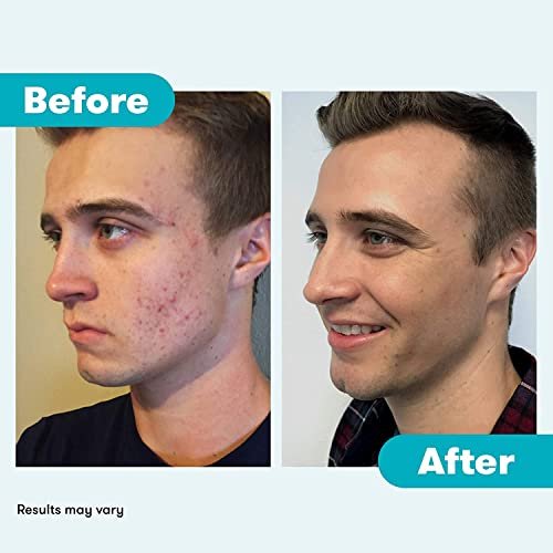 Proactiv Repair Acne Treatment Benzoyl Peroxide Spot Treatment and Repairing Serum – 3 Fl Oz Avelisse