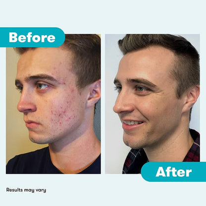 Proactiv Repair Acne Treatment Benzoyl Peroxide Spot Treatment and Repairing Serum – 3 Fl Oz Avelisse