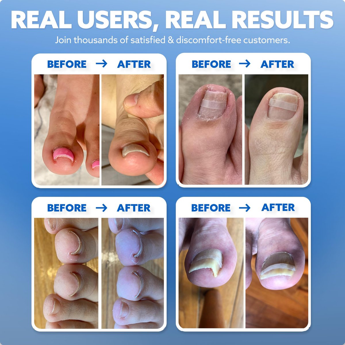 CurveCorrect Ingrown Toenail Treatment Kit – 10 Clear Braces for Pain Relief & Curved Toe Correction Avelisse