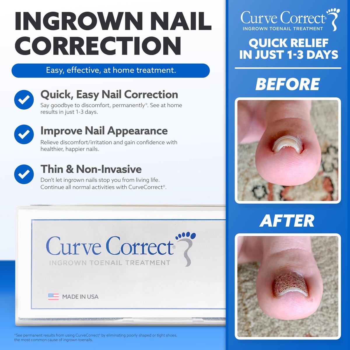CurveCorrect Ingrown Toenail Treatment Kit – 10 Clear Braces for Pain Relief & Curved Toe Correction Avelisse