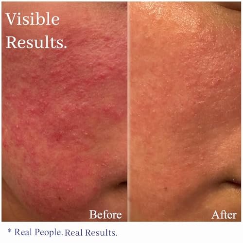 Hey Honey Skincare Relax - Instant Rosacea Relief Cream for Sensitive Skin | Calming Face Moisturizer for Facial Redness & Irritation | Dermatologist Tested, Oil-Free with Honey & Propolis | 2.2 Oz Avelisse