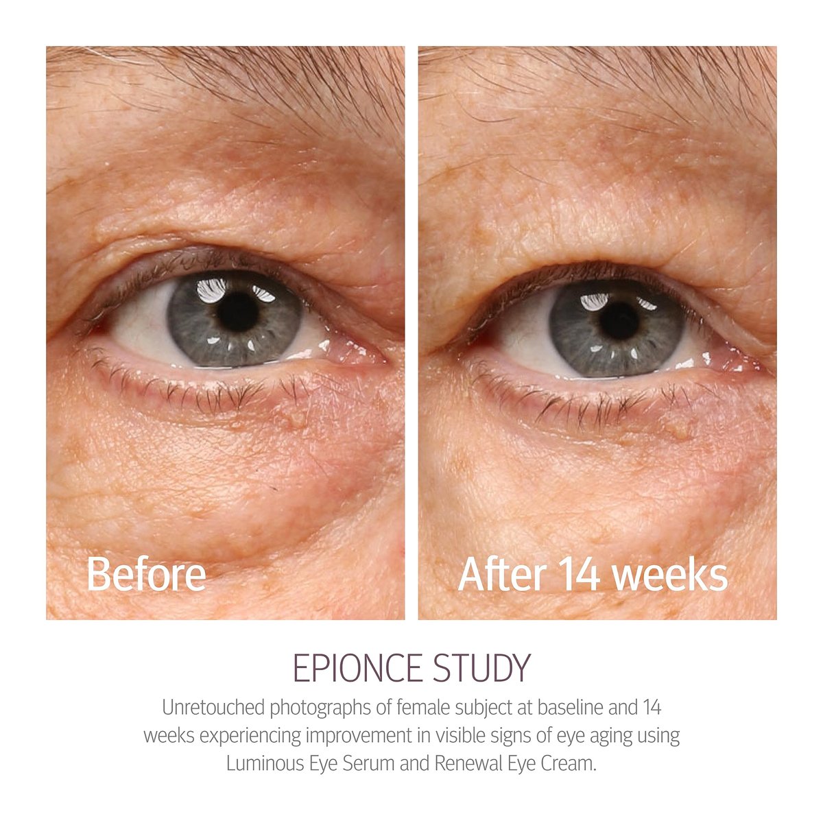 Epionce Renewal Eye Cream – Anti-Aging Under Eye Cream for Dark Circles, Fine Lines, Wrinkles & Puffiness with Hyaluronic Acid, All Skin Types, Dermatologist Skincare Avelisse