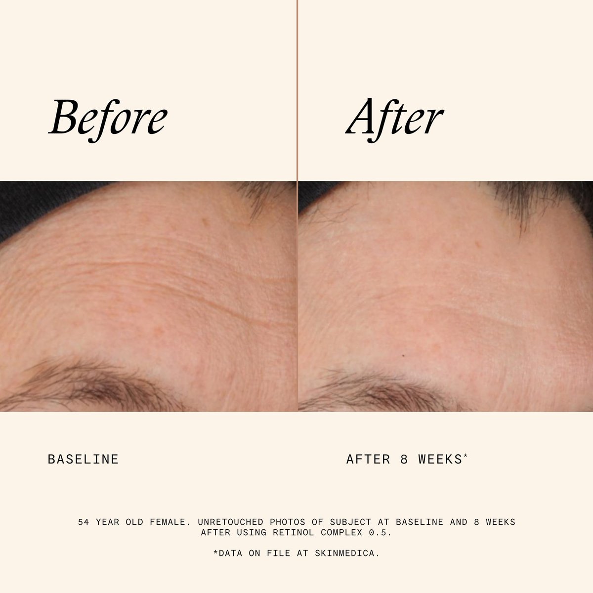 SkinMedica Retinol 0.5 Complex - Age-Defying Retinol Serum for Face, Reduces Fine Lines & Wrinkles, 1 Fl Oz Avelisse