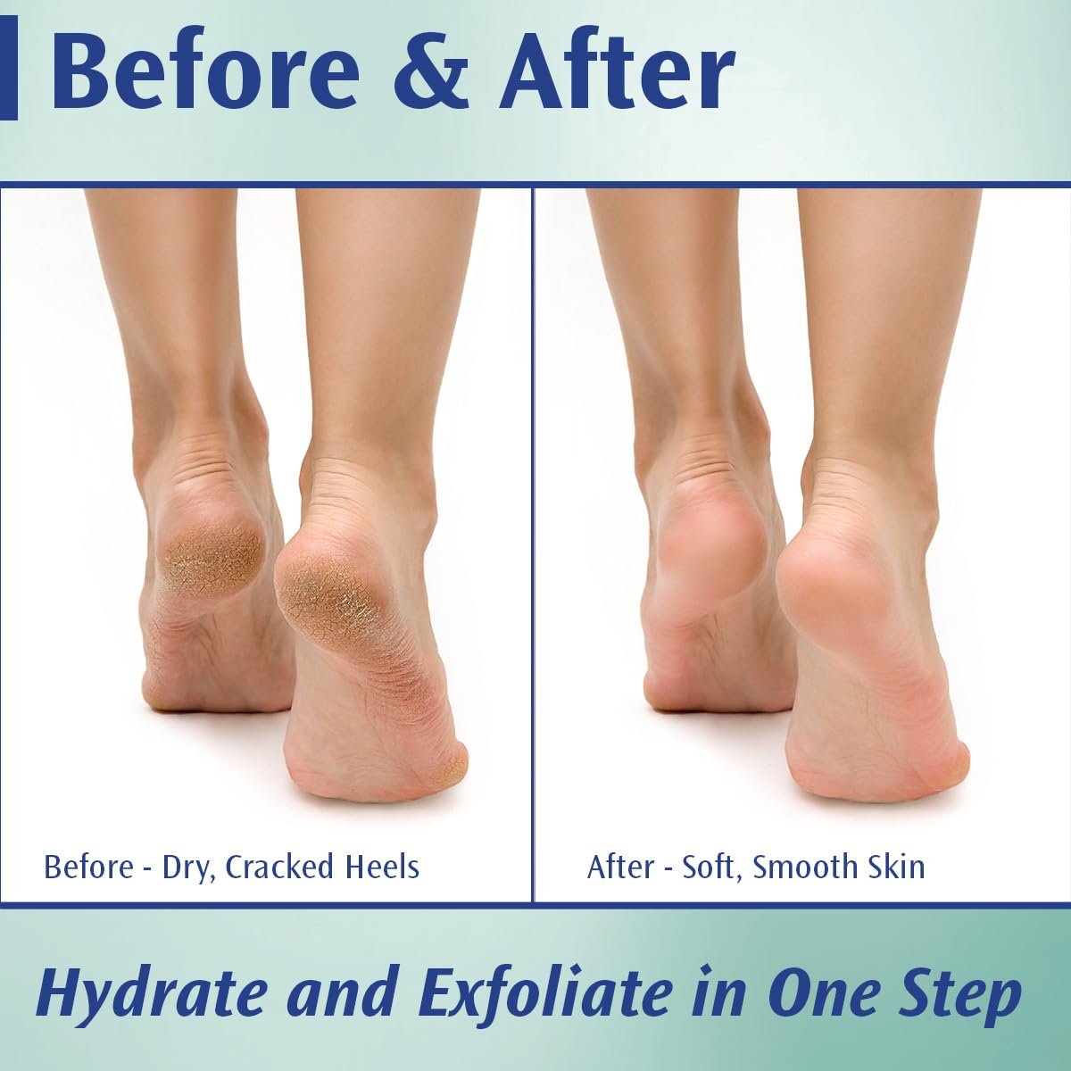 Pedifix Podiatrists' Choice 20% Urea Callus Control Extra Strength Foot Cream - 4 oz - Professional Treatment for Dry, Cracked Feet & Callus Relief Avelisse