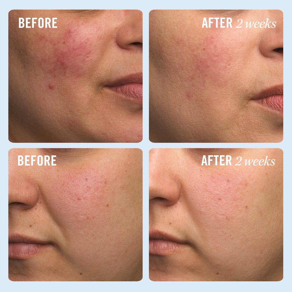 First Aid Beauty Ultra Repair Cream - Intense Hydration Face & Body Moisturizer with Whipped Colloidal Oatmeal - Clinically Proven to Strengthen Skin Barrier in 7 Days - Helps Relieve Eczema, 1 oz - görsel 5