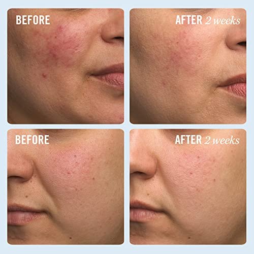 First Aid Beauty Ultra Repair Cream - Intense Hydration Face & Body Moisturizer with Whipped Colloidal Oatmeal - Clinically Proven to Strengthen Skin Barrier in 7 Days - Helps Relieve Eczema, 1 oz - görsel 6