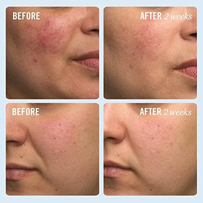 First Aid Beauty Ultra Repair Cream - Intense Hydration Face & Body Moisturizer with Whipped Colloidal Oatmeal - Clinically Proven to Strengthen Skin Barrier in 7 Days - Helps Relieve Eczema, 1 oz