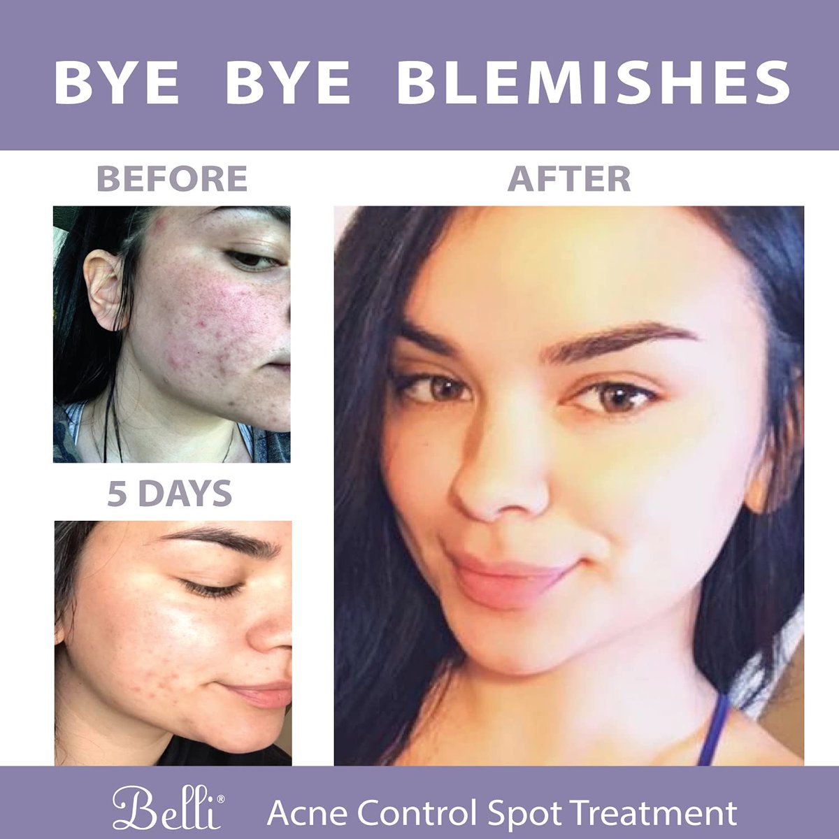 Belli Skincare Acne Control Spot Treatment - 0.5 Fl Oz - Vegan & Pregnancy-Safe Acne Spot Treatment for Face Avelisse