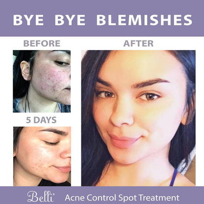 Belli Skincare Acne Control Spot Treatment - 0.5 Fl Oz - Vegan & Pregnancy-Safe Acne Spot Treatment for Face Avelisse