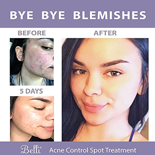 Belli Skincare Acne Control Spot Treatment - 0.5 Fl Oz - Vegan & Pregnancy-Safe Acne Spot Treatment for Face Avelisse