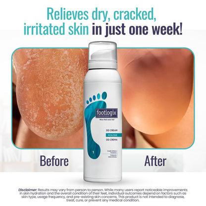 FOOTLOGIX DD Cream Mousse - Intensive Foot Moisturizer for Dry, Cracked Feet - 4.23 oz Avelisse