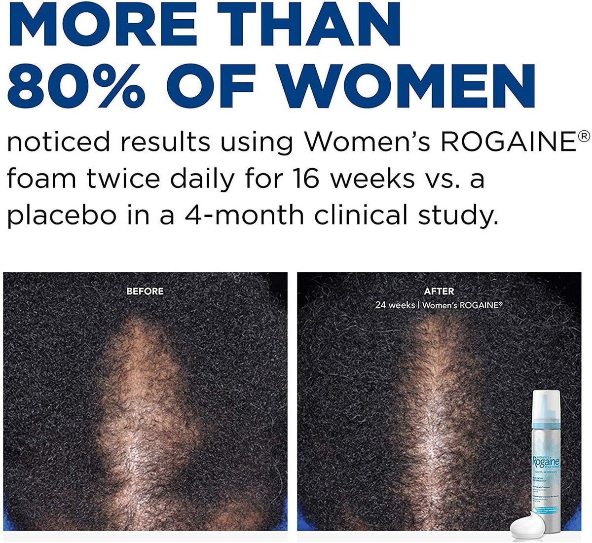 Rogaine 5% Minoxidil Foam for Women – Once-Daily Hair Regrowth Treatment, Unscented, 2-Month Supply (2.11 oz) Avelisse