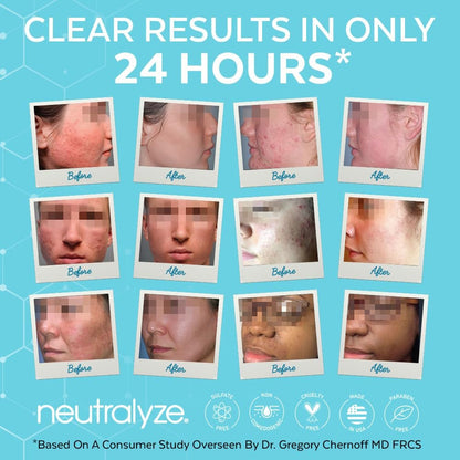 Neutralyze Moderate to Severe Acne Face Wash 2.0 – Maximum Strength 2% Mandelic Acid & 2% Salicylic Acid Facial Cleanser for Acne Prone Skin, 5 FL OZ
