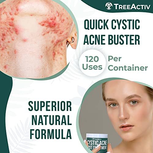 TreeActiv Cystic Acne Spot Treatment Paste with Sulfur, Bentonite Clay, and Tea Tree Oil - Deep Breakouts, 20-Minute or Overnight Application, 0.5 oz Avelisse