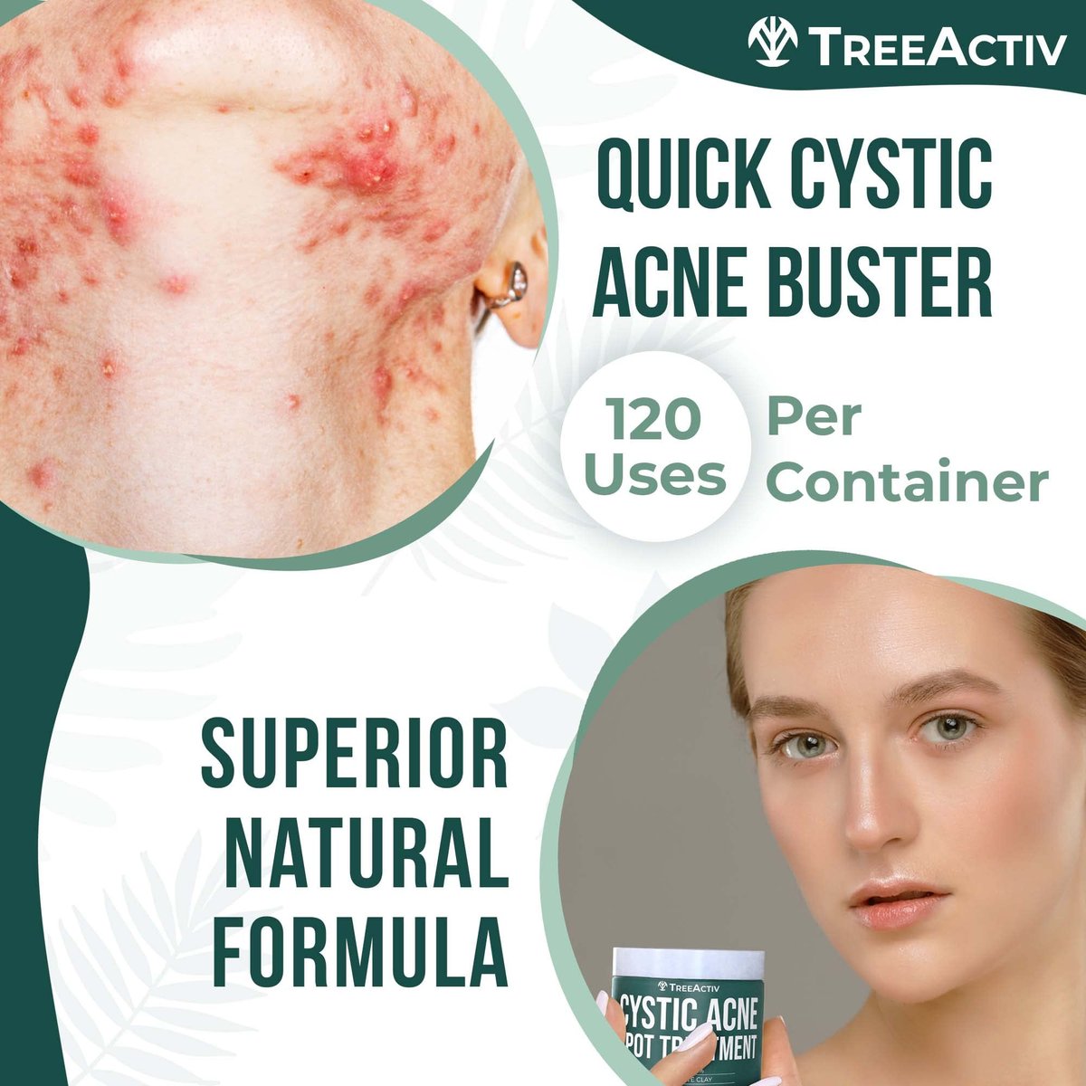TreeActiv Cystic Acne Spot Treatment Paste with Sulfur, Bentonite Clay, and Tea Tree Oil - Deep Breakouts, 20-Minute or Overnight Application, 0.5 oz Avelisse