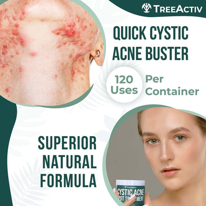TreeActiv Cystic Acne Spot Treatment Paste with Sulfur, Bentonite Clay, and Tea Tree Oil - Deep Breakouts, 20-Minute or Overnight Application, 0.5 oz Avelisse
