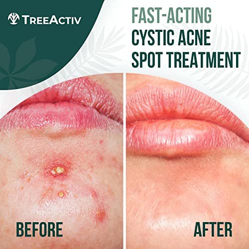 TreeActiv Cystic Acne Spot Treatment Paste with Sulfur, Bentonite Clay, and Tea Tree Oil - Deep Breakouts, 20-Minute or Overnight Application, 0.5 oz Avelisse