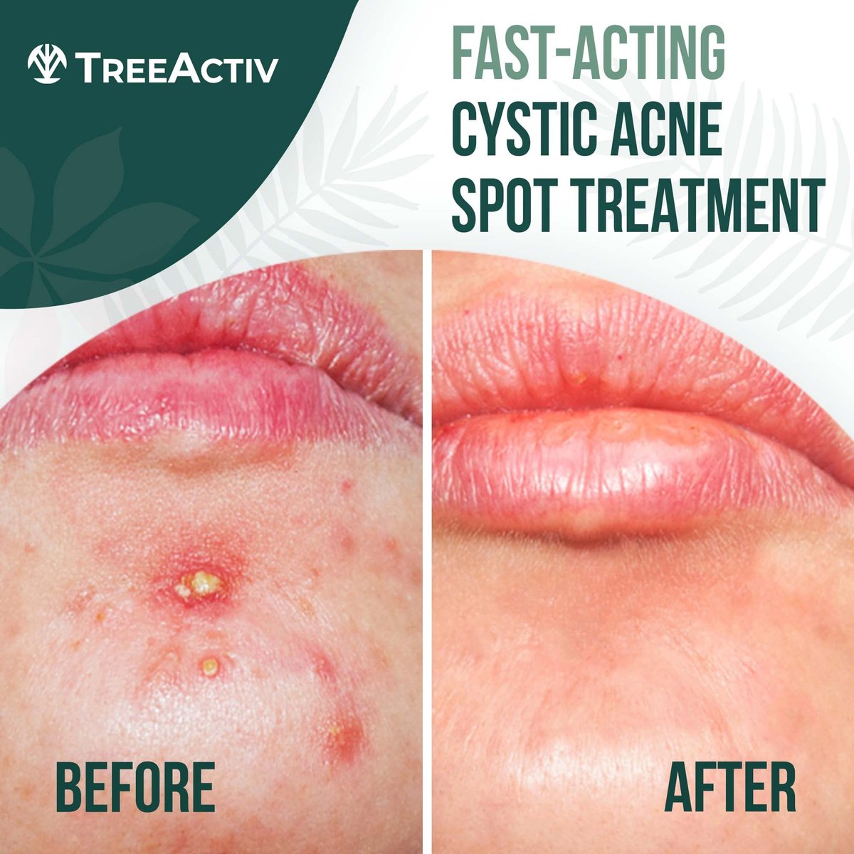 TreeActiv Cystic Acne Spot Treatment Paste with Sulfur, Bentonite Clay, and Tea Tree Oil - Deep Breakouts, 20-Minute or Overnight Application, 0.5 oz Avelisse